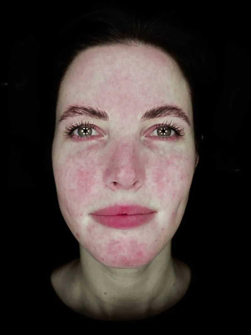 320-redness-scaled