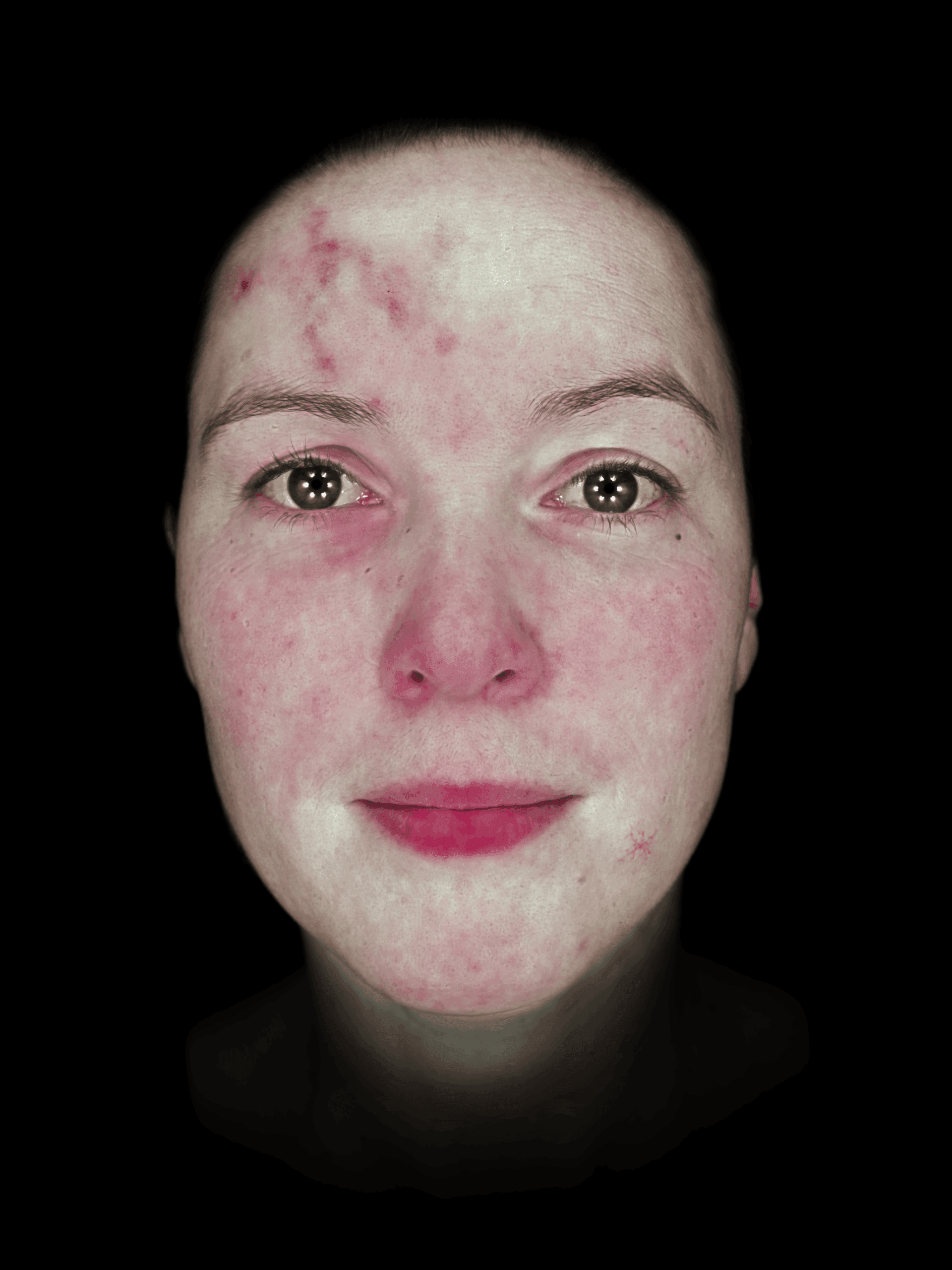 observ_qrc_520x_2020-model_redness